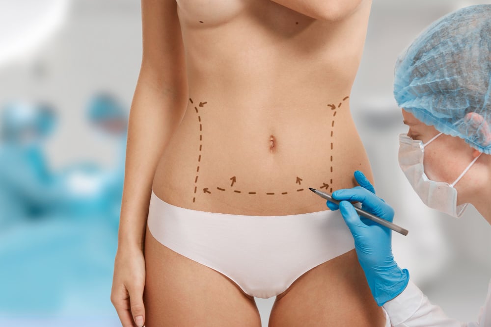 Abdominoplasti