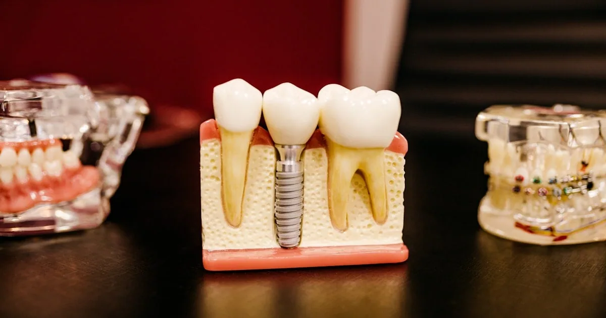 Dental Implants in Turkey 2026: Prices, Clinics & What to Expect