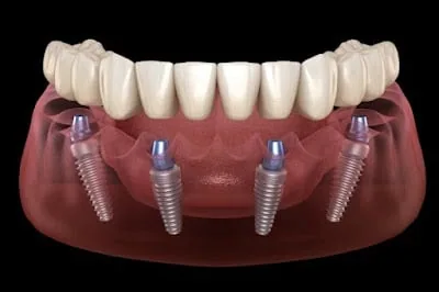 Dental Implantologist UAE