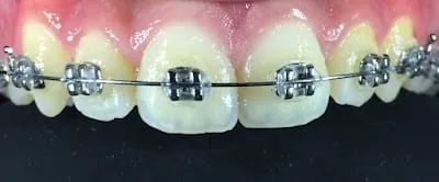 İzmit Çocuk Diş hekimi ve Ortodonti Kliniği- genel anestezi ile diş tedavileri-diş teli- implant- zirkonyum