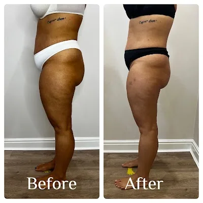 Endermika -Endermologie LPG