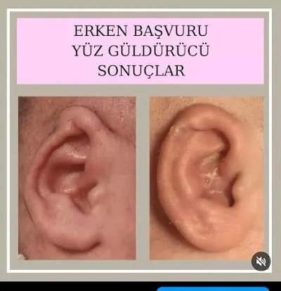 ANTALYA KULAK ŞEKİLLENDİRME