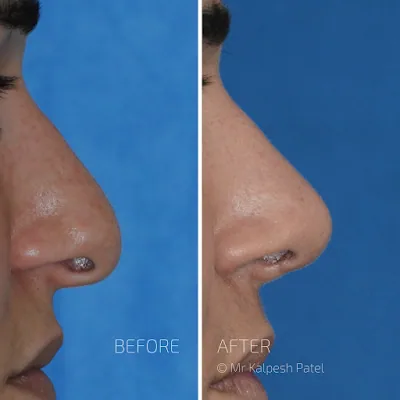 London Rhinoplasty