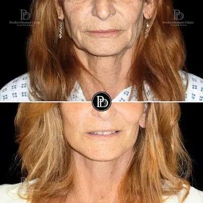 Perfect Doctors Clinic Dubai Rhinoplasty BBL Liposuction Gynecomastia tummy tuck facelift Breast body lift butt fillers botox