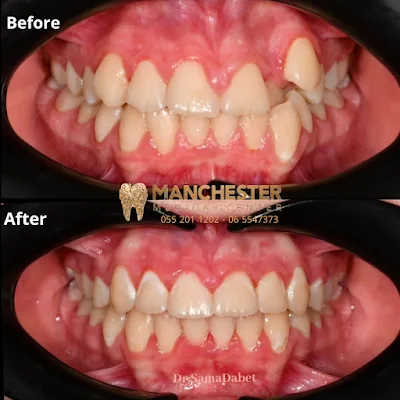 Manchester Medical Centre-Veneers